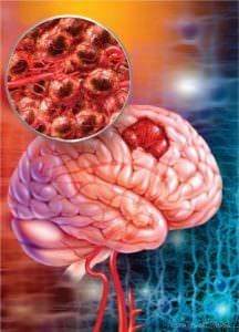 Tumors in Brain